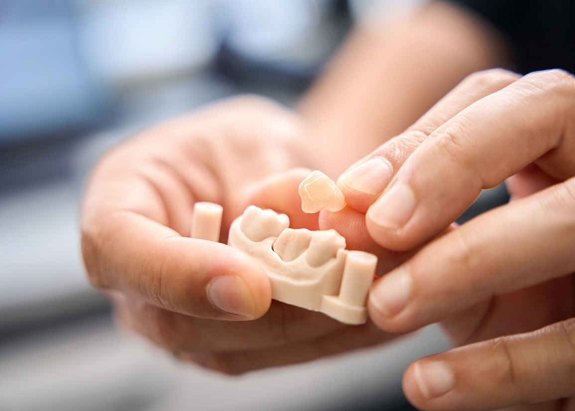 Crowns & Bridges: A Long-Lasting Way to Rebuild Your Smile – Telegraph