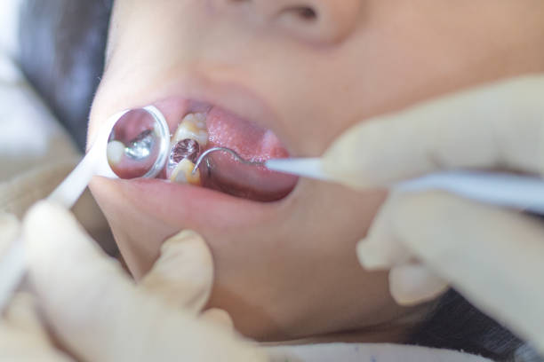 What Affects the Longevity of Dental Implants – Telegraph