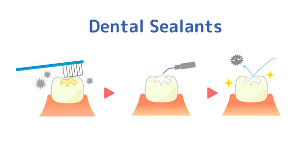 When Should Dental Sealants Be Applied? – Telegraph